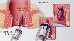  Emorroidi: terapia ambulatoriale, legatura elastica
